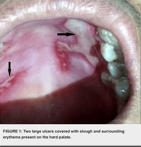 Figure 1 From Management Of A Large Palatal Ulcer Mucous Membrane