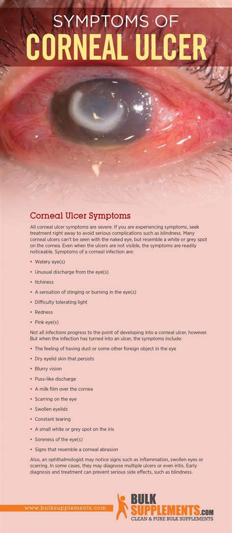 Tablo Read Corneal Ulcer Characteristics Causes And Treatment By