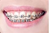 Silver Crowns Teeth Cost Pictures
