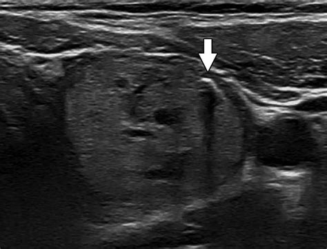 Peripheral Thyroid Nodule Calcifications On Sonography Evaluation Of Malignant Potential Ajr