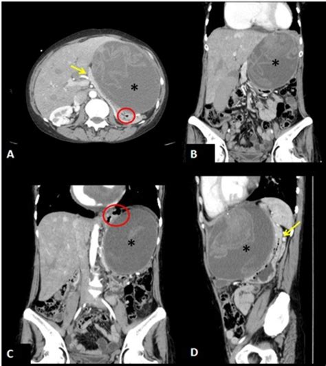 Enhanced Abdominal Ct In A Axial Scan Coronal Reconstruction B And