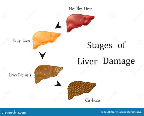 Stages Of Liver Disease