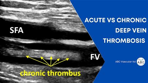 Acute And Chronic Deep Vein Thrombosis Vein Diameter Variation