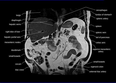 Thank you for visiting labeled abdominal gross anatomy pictures pictures. anatomy human abdomen | MRI abdomen coronal anatomy | free cross sectional anatomy | | Mri, Pet ...