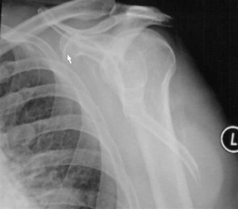 Old Healed Fracture Of Right Scapula And Clavicle