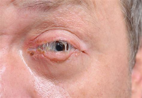 Bacterial Conjunctivitis What Is It And Treatment Área Oftalmológica