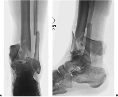 Chapter 63 Tibial Pilon Fractures Orthoracle Luanmd