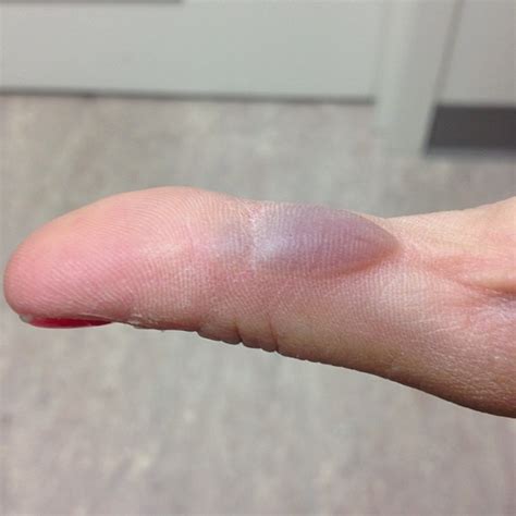 Thumb Update The Hot Glue Induced Burn Now Has A Purple Blister