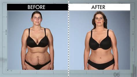 Belly Butt From Botched Patients Before And After—shocking Transformations