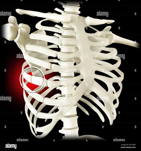 Anatomy And The Human Body Costochondral Separation Separated Rib Broken Fractured Ribs