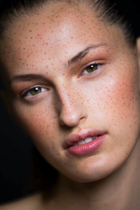 7 Reasons To Love Your Freckles Immediately — Theyre A Form Of