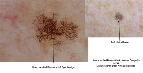 Dermoscopy Made Simple Ink Spot Lentigo