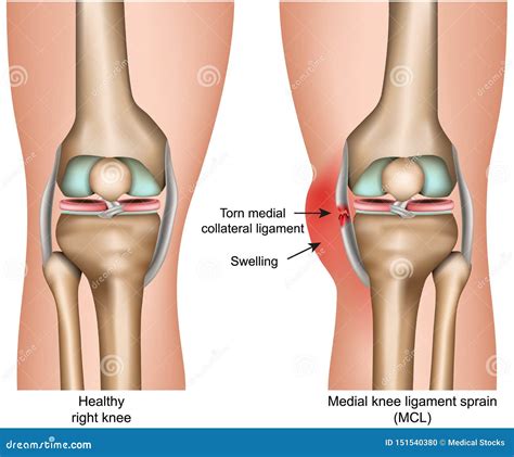 Medial Knee Ligament Sprain Medical Vector Illustration Isolated On