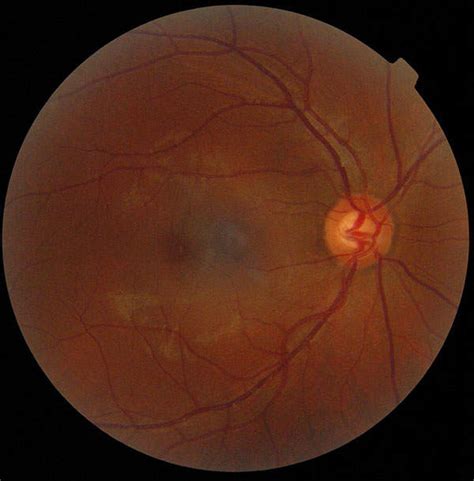 Lucentis Ranibizumab For The Treatment Of Diabetic Macular Edema Dme