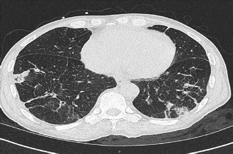 What Does A Chest Ct Scan Without Contrast Show Ct Scan Machine Images