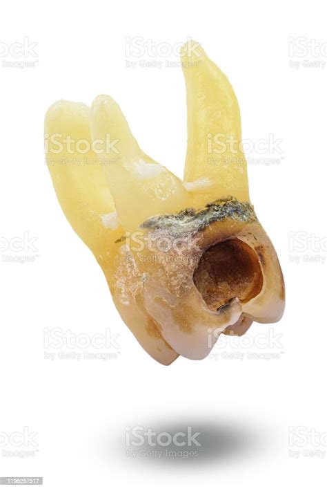 Extracted Caries Tooth Isolated On White Background Stock Photo