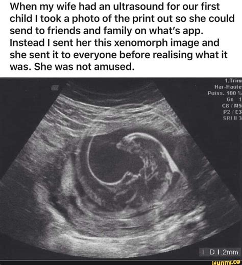 When My Wife Had An Ultrasound For Our First Child I Took A Photo Of