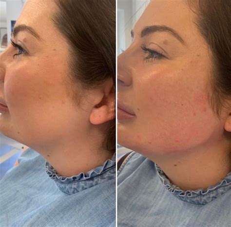Dermal Fillers Bromsgrove Fight The Signs Of Ageing Charlarts