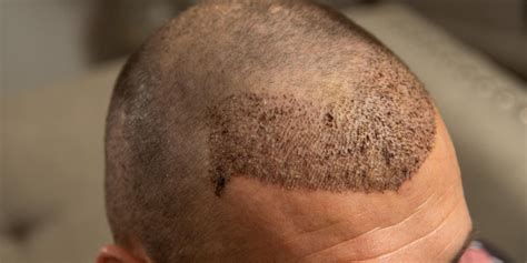 How Much Is A Hair Transplant In Turkey Asli Tarcan Clinic