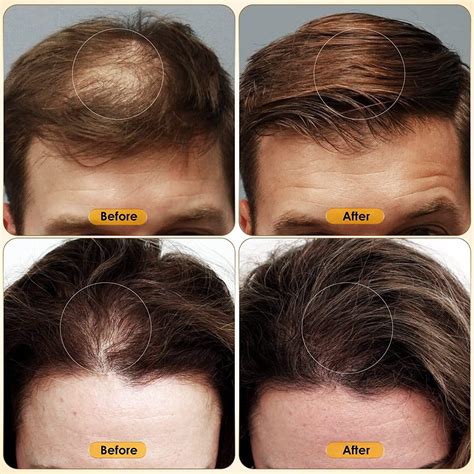 Minoxidil 5 Hair Growth Serum Oil Biotin Hair Regrowth Treatment For Scalp Hair Loss Hair