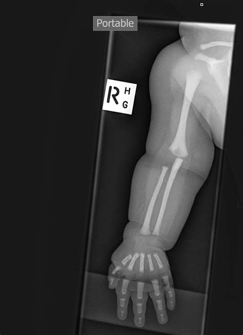 Normal Child Wrist X Ray