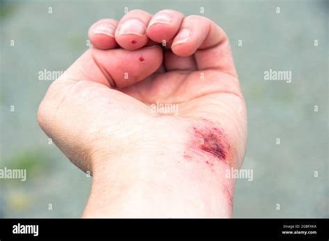 Red Wound On The Palm Hand Wrist After A Burn Or Fall Close Up