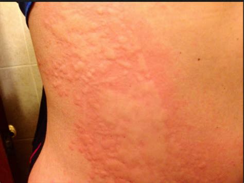 Hives Skin Inflammation Causes Symptoms And Treatments