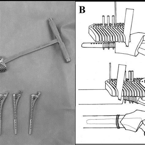 V Shaped Subtrochanteric Osteotomy Device And Its Usage A Photograph