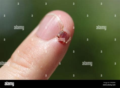 Open Sores Hi Res Stock Photography And Images Alamy