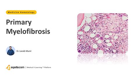 Primary Myelofibrosis Etiology Pathogenesis Diagnosis