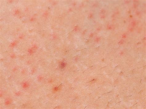 Skin Diseases You Can Get At The Gym Including Ringworm And Warts