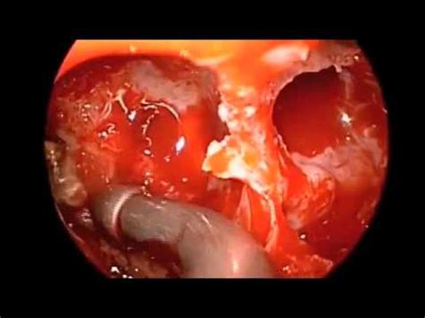 Your doctor will remove the lining of your nasal cavities and test it to determine if you have a fungal sinus infection. Maxillary Fungal Sinusitis - YouTube - YouTube