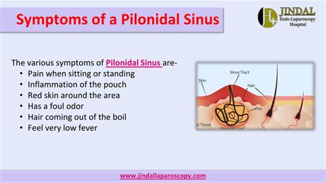 Ppt Best Treatment For Pilonidal Sinus By Jindal Laparoscopy Hospital Powerpoint Presentation