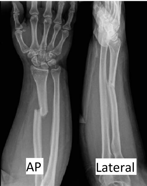 Cureus Isolated Nerve Palsy Of The Flexor Pollicis Longus After A Radial Shaft Fracture A