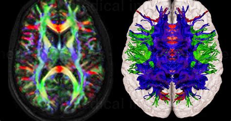 Why White Matter Matters Diffusion Tensor Imaging Psychology Today