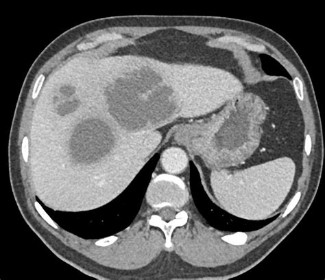 Multiple Liver Abscesses Liver Case Studies Ctisus Ct Scanning
