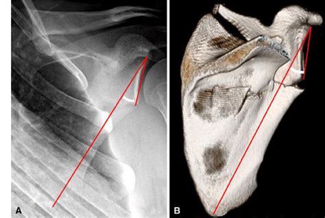 Scapula Fractures Trauma Orthobullets