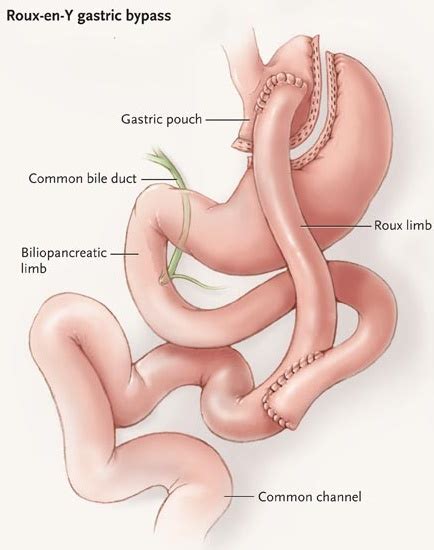 Gastric Bypass Surgery Penn Medicine