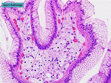 Qiaos Pathology Gastric Xanthoma Xanthelasma A Photo On Flickriver