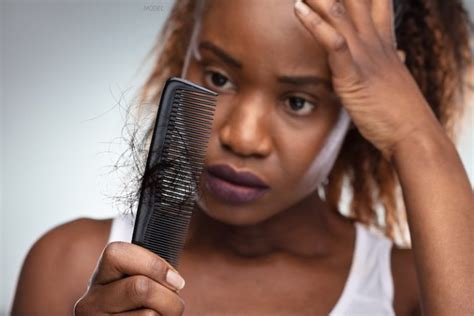 What Causes Female Hair Loss Frank Agullo Md