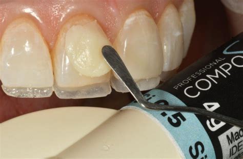 Optident Launches White Dental Beauty Composite Optident
