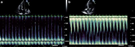 Respiratory Variations In Flow Velocities By Spectral Doppler During