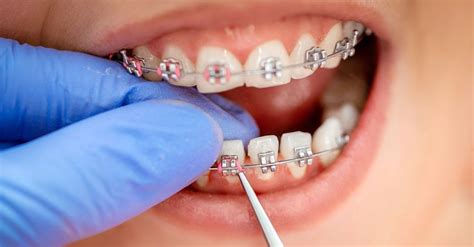 Orthodontic Specialists Provide Various Brace Types Sendika8