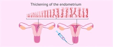 Endometrial Preparation For Embryo Transfer