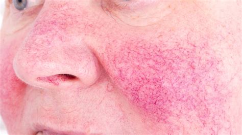 10 Facts About Rosacea Mental Floss