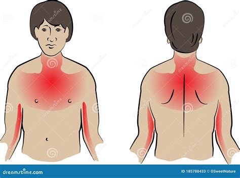 Heart Attack Pain Locations Medical Illustration Stock Illustration