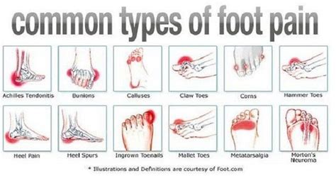 This occurs when a tendon or ligament pulls a small piece of the fifth. Pin on Health