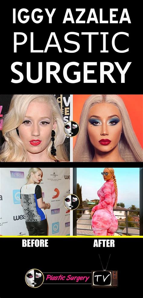 Iggy Azalea Plastic Surgery Before And After Video