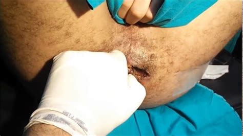 Maybe you would like to learn more about one of these? Perianal Fistula: The Simplest Cure (HD) ناسور شرجي بلا ...