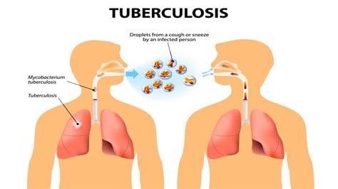 Early Warning Signs And Symptoms Of Tuberculosis Youtube